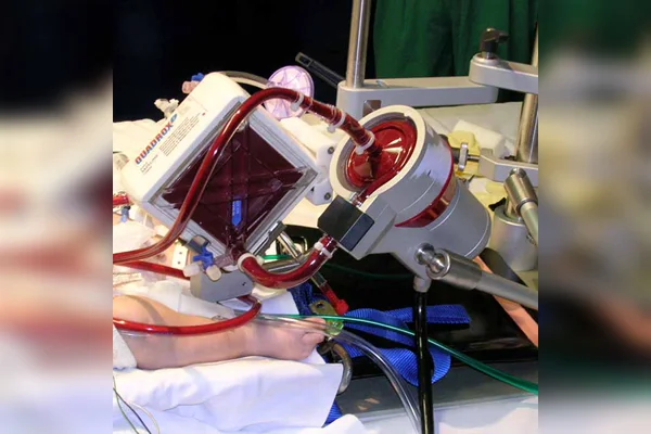 ECMO therapy