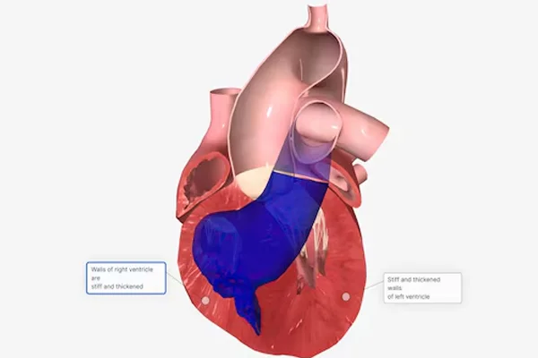 Treatment of Atrial Septal Defects