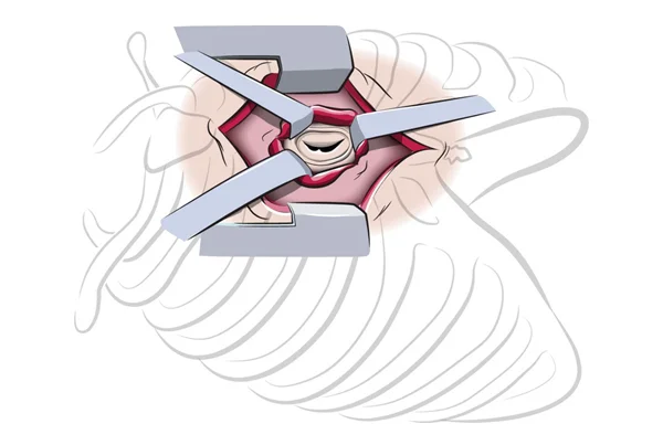 Aortic Valve Repair and Replacement